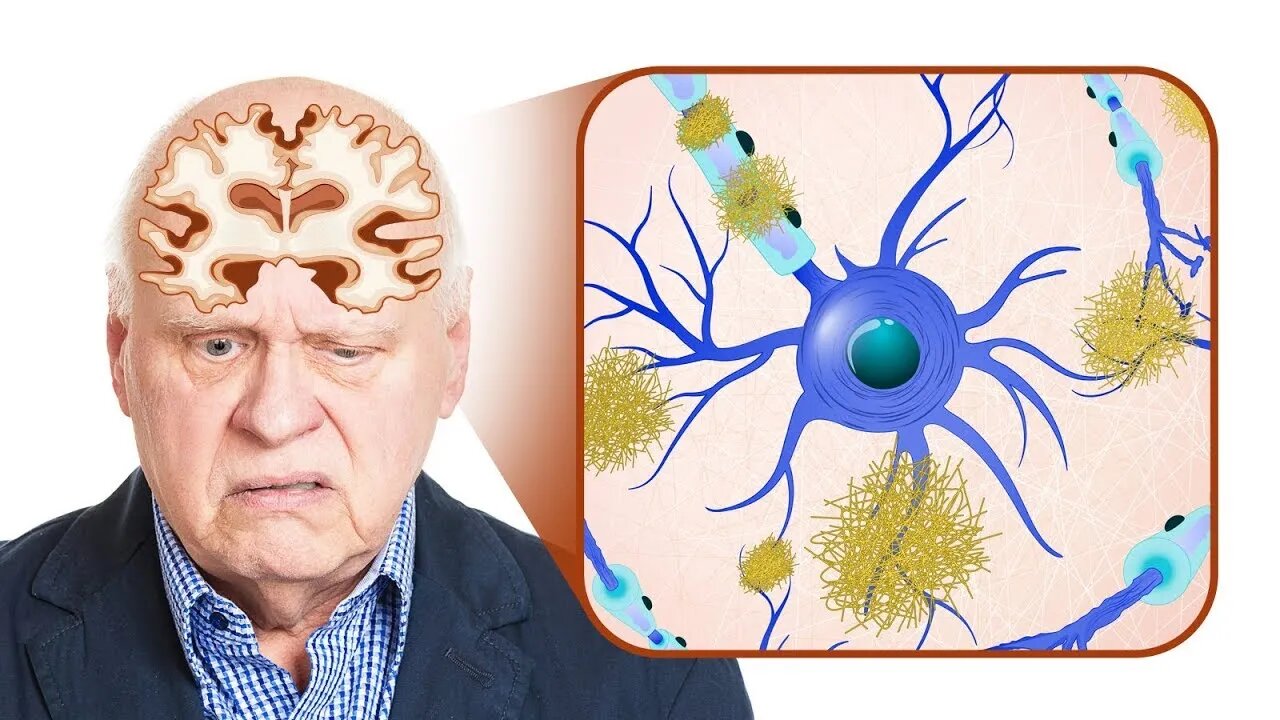 Genetically at Risk for Alzheimer's Disease DO THIS...