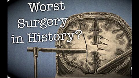 The Dark side of Science: The Lobotomy, the worst surgery in history?