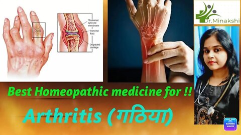 Best homeopathic medicine combination for Arthritis #arthritis #गठिया