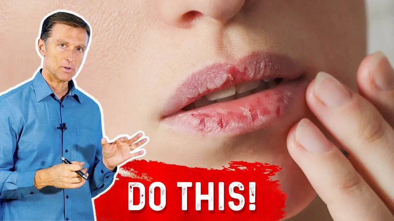 How To Fix Your Chapped Lips? – Dr.Berg On Remedy For Chapped Lips