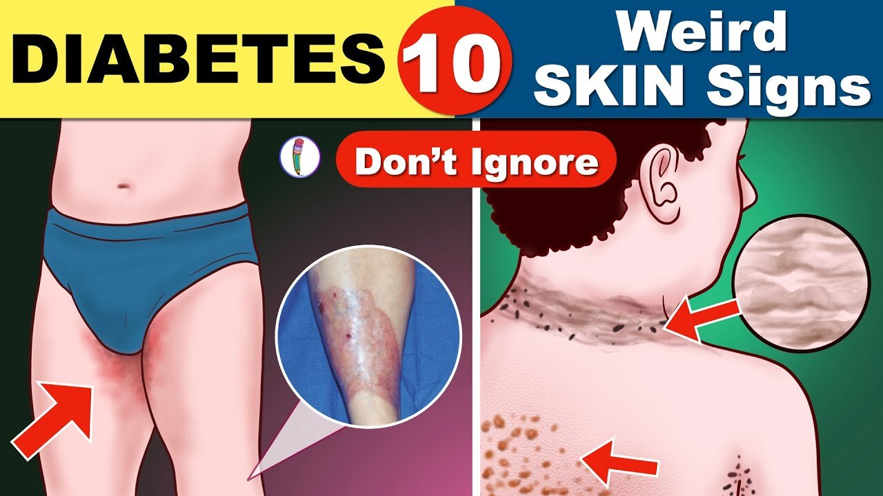 Diabetes skin signs | Diabetes symptoms | Signs of Diabetes | Diabetes mellitus