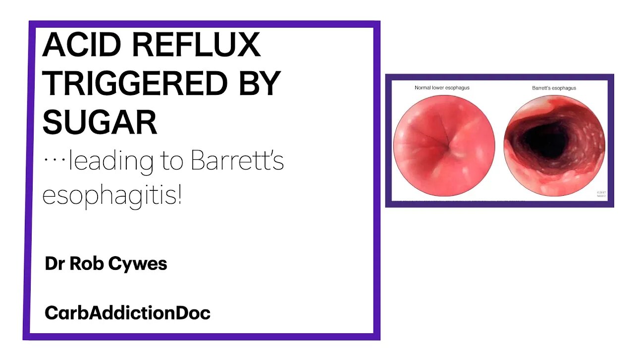 CarbAddictionDoc 3: ACID REFLUX TRIGGERED BY SUGAR...leading to Barrett's esophagitis