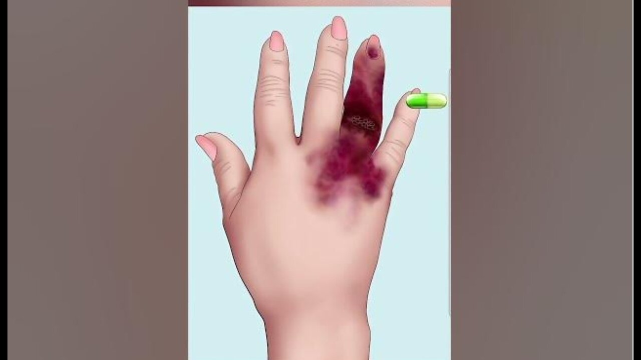 How a infection heals - Short! VEIWER DISGRESSION!!!