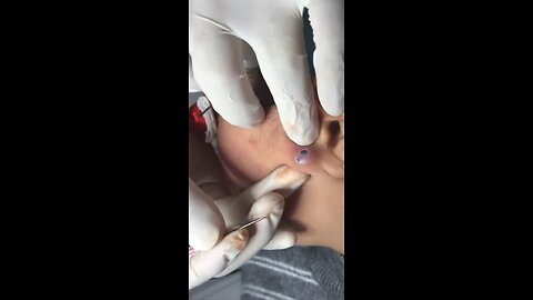 blackhead