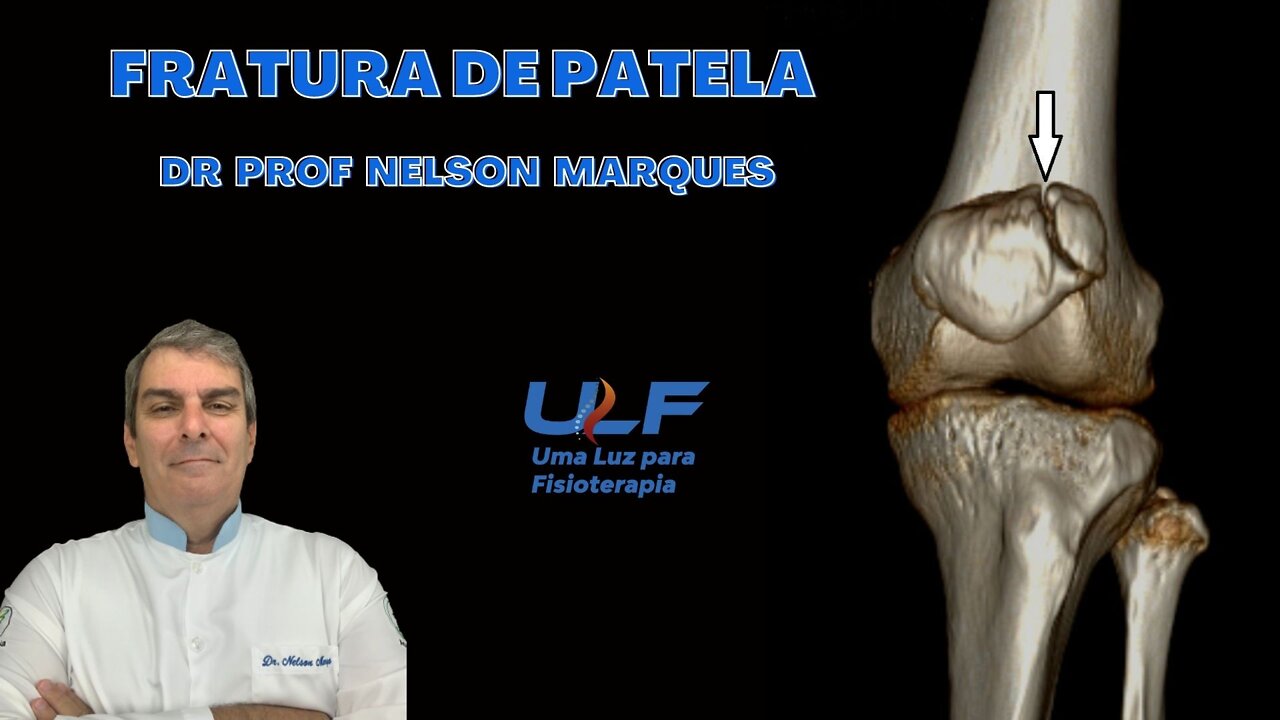 FRATURA DE PATELA - Dr. Prof. Nelson Marques