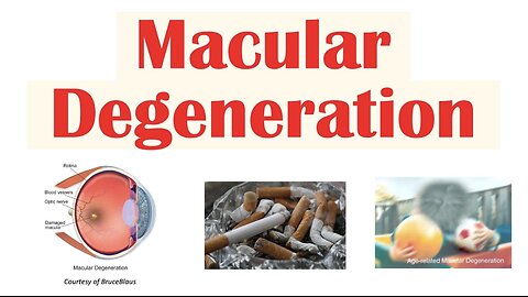 Macular Degeneration | Wet vs Dry | Risk Factors, Pathophysiology, Symptoms, Diagnosis, Treatment