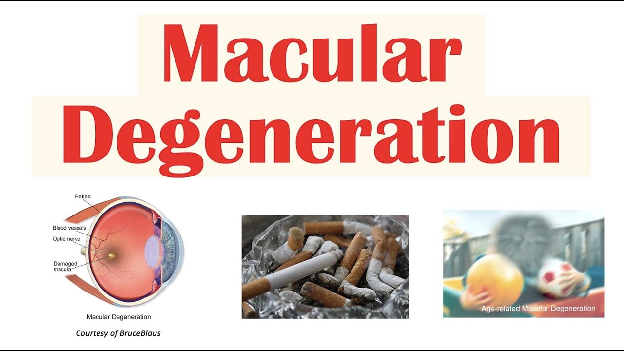 Macular Degeneration | Wet vs Dry | Risk Factors, Pathophysiology, Symptoms, Diagnosis, Treatment