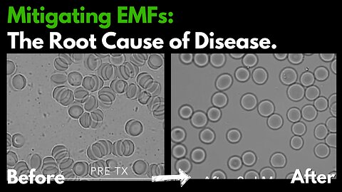 Live Blood Analysis: Eliminating EMF Toxicity : The Root Cause of Chronic Disease