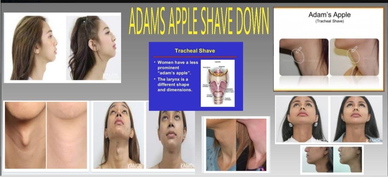 Adam's Apple Exposed