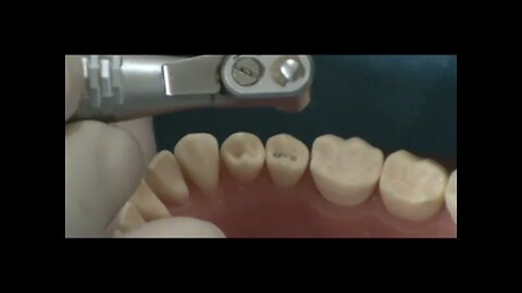 Class I Lower Right Second Premolar