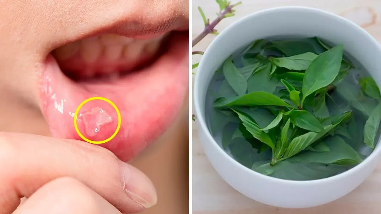 How To Cure Mouth Ulcers Naturally