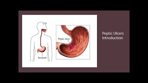 Peptic Ulcers - Introduction