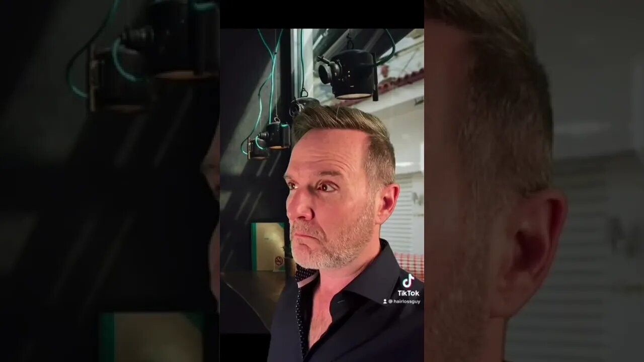 Hair Transplant TikToks I found today.