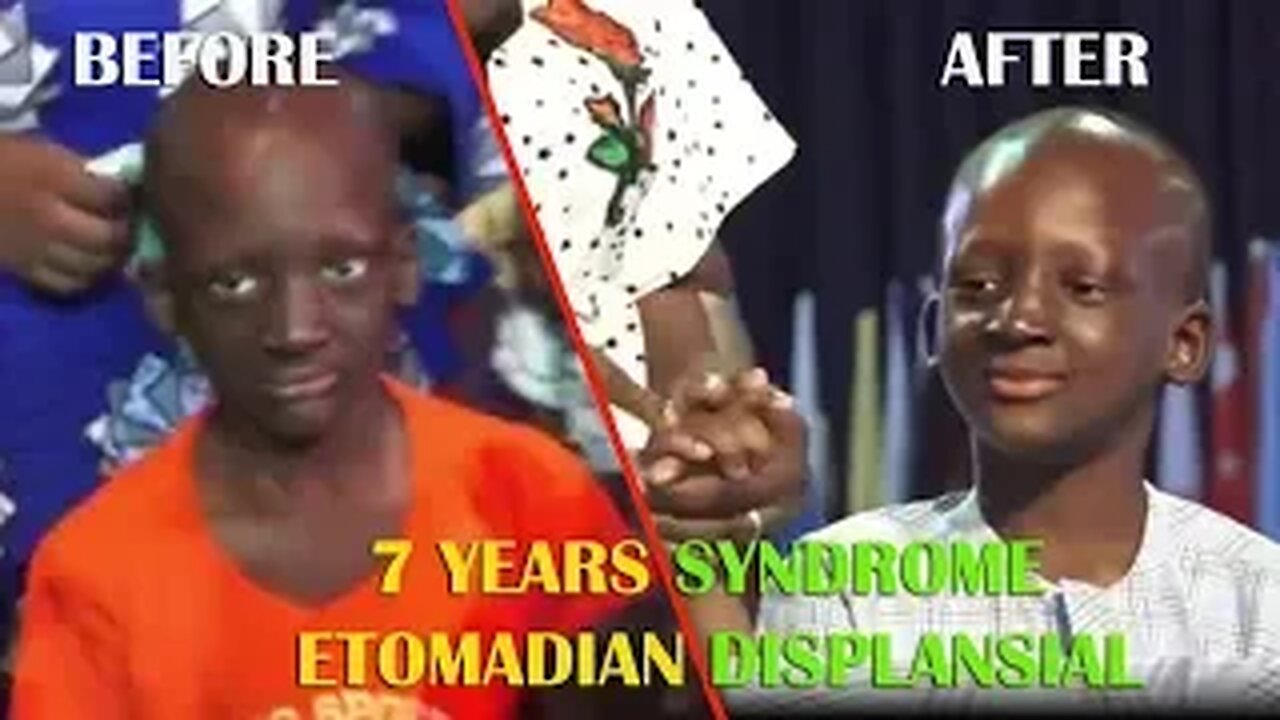 OCHE JAMES SUFFERS 7 YEARS syndrome etomadian displansial [testimony]