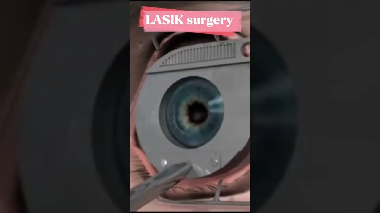 LASIK - a type of refractive surgery for the correction of refractive errors tiktok biopsychosociale