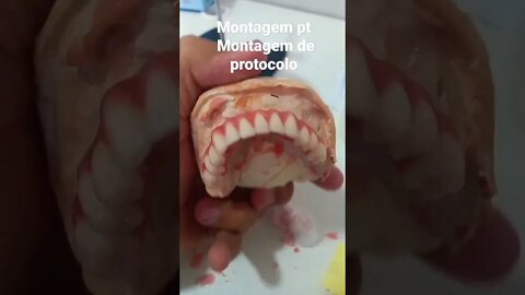 como montar uma Prótese protocolo