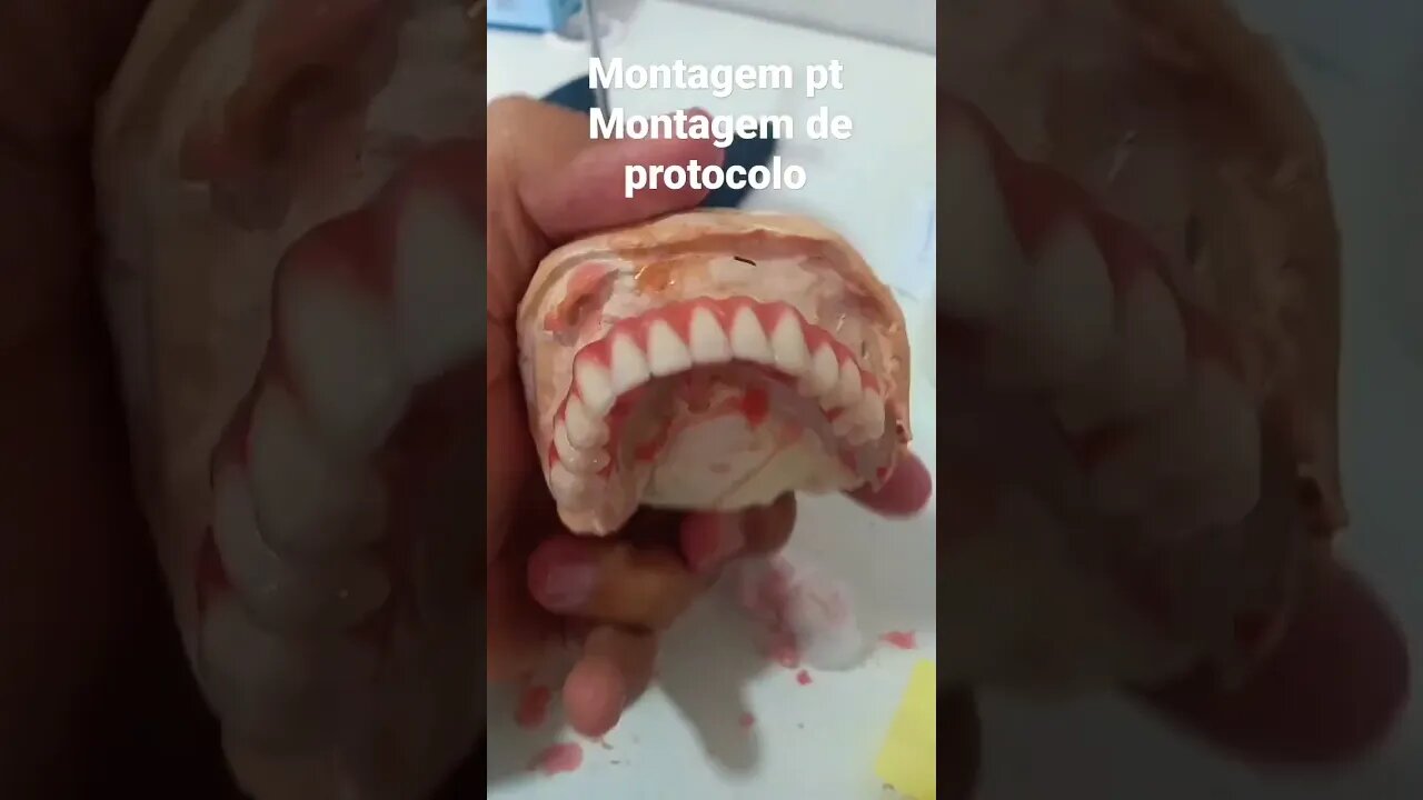 como montar uma Prótese protocolo