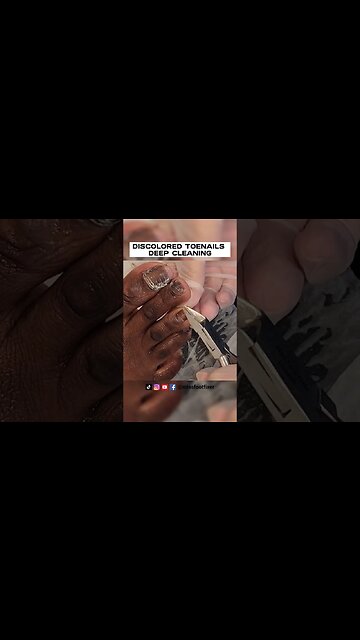 CLEANING TOENAIL 🦶🏽: DISCOLORED TOENAILS DEEP CLEANING BY FAMOUS PODIATRIST MISS FOOT FIXER