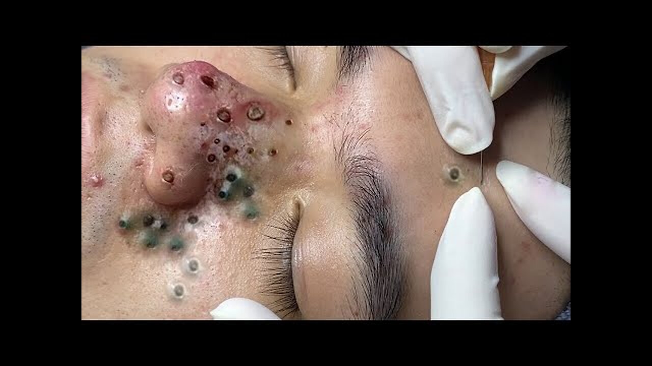 Blackheads Whiteheads Removal Dr Pimple Popper Cystic Acne Extraction 789