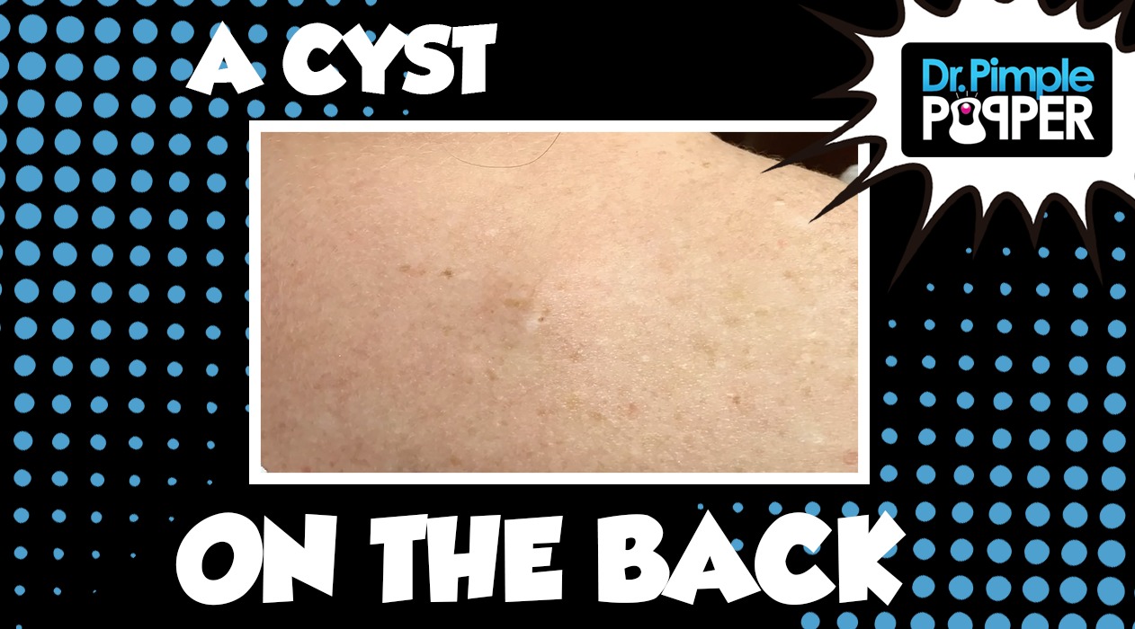 A Cyst on the Back