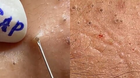 Whitehead removal (Warning: So satisfying)