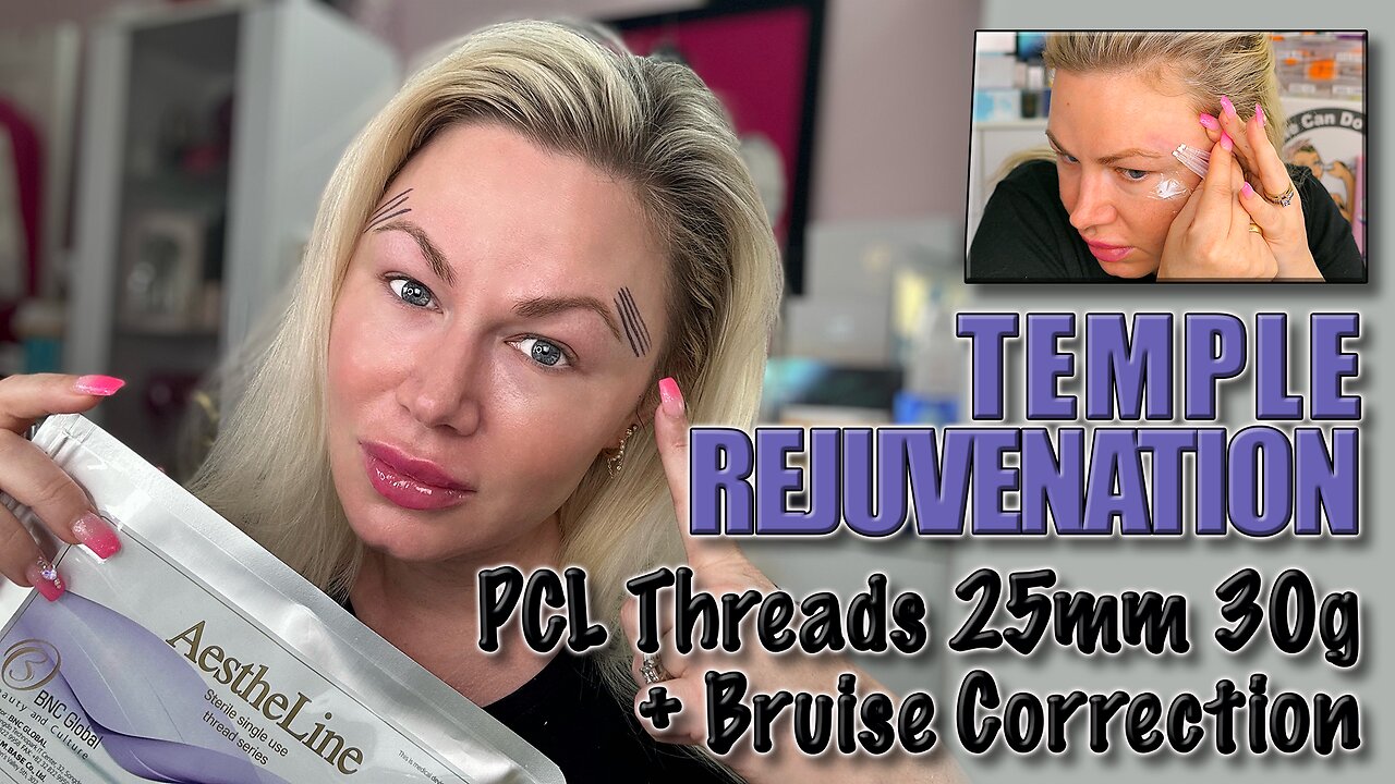 Temple Rejuvination with PCL Screw threads & Bruise correction! AceCosm, Code Jessica10 Saves