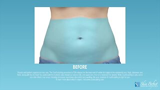 MD Body MedSpa- Coolsculpting After Your Sweet Treats This Fall