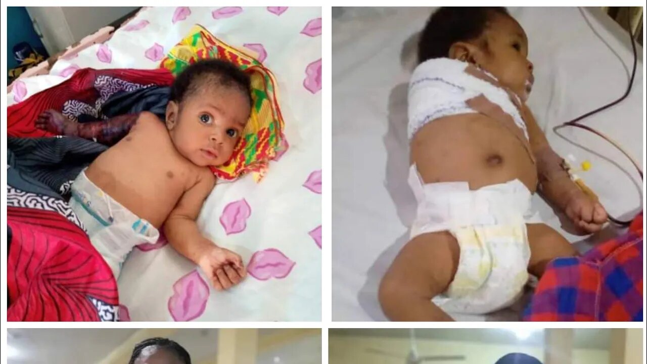 2-month-old baby boy left with arm amputated after father allegedly beats him with hanger