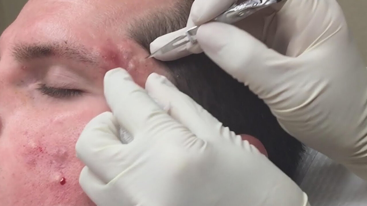 blackhead removal