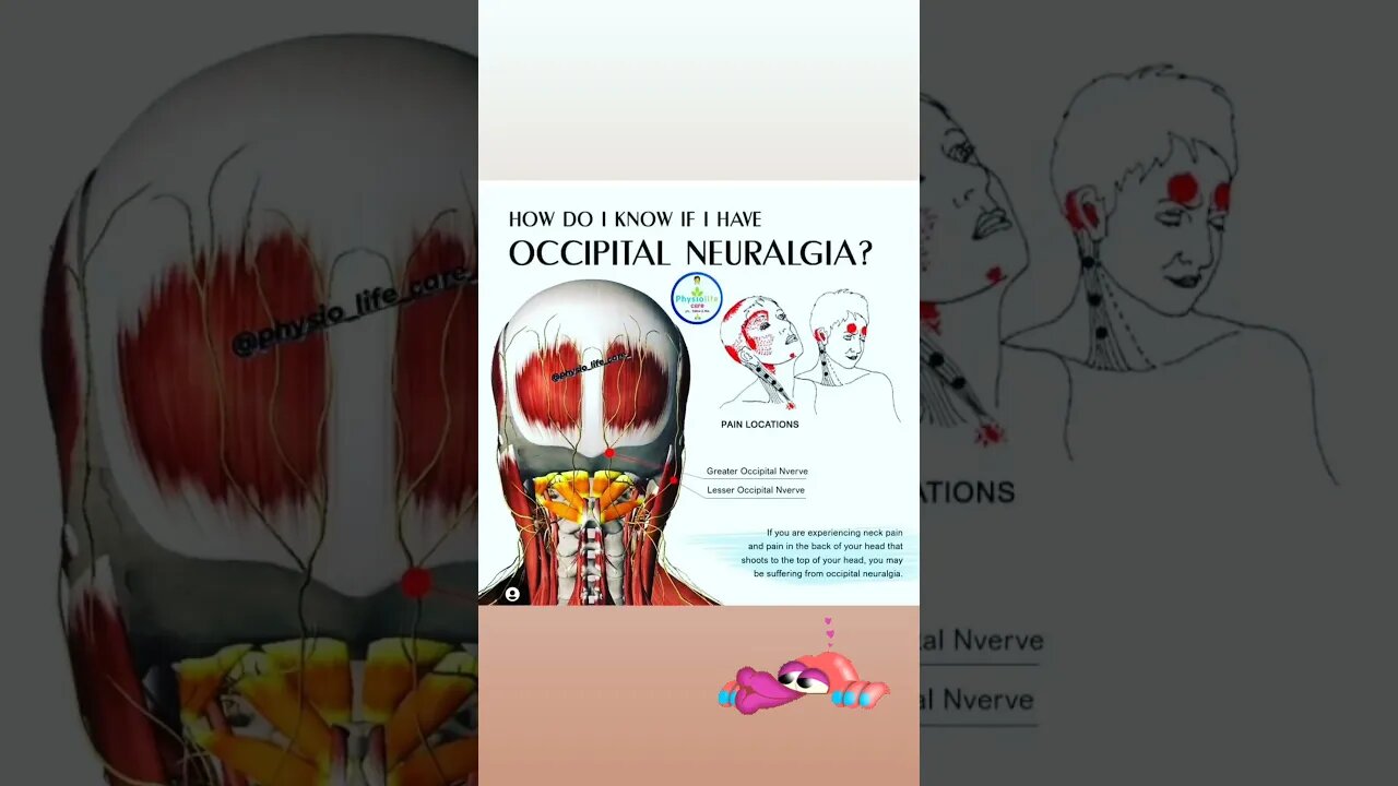 OCCIPITAL NEURALGIA