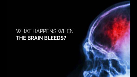 Brain Bleeds, Heart Attacks in Younger 50-Year-Olds. WHO will Admit This Is from the Vaccine