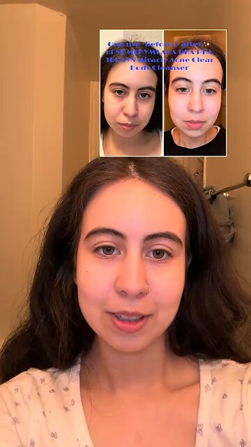 First impressions- AHA BHA PHA 30 Days Miracle Acne Clear Body Cleanser TEATREE