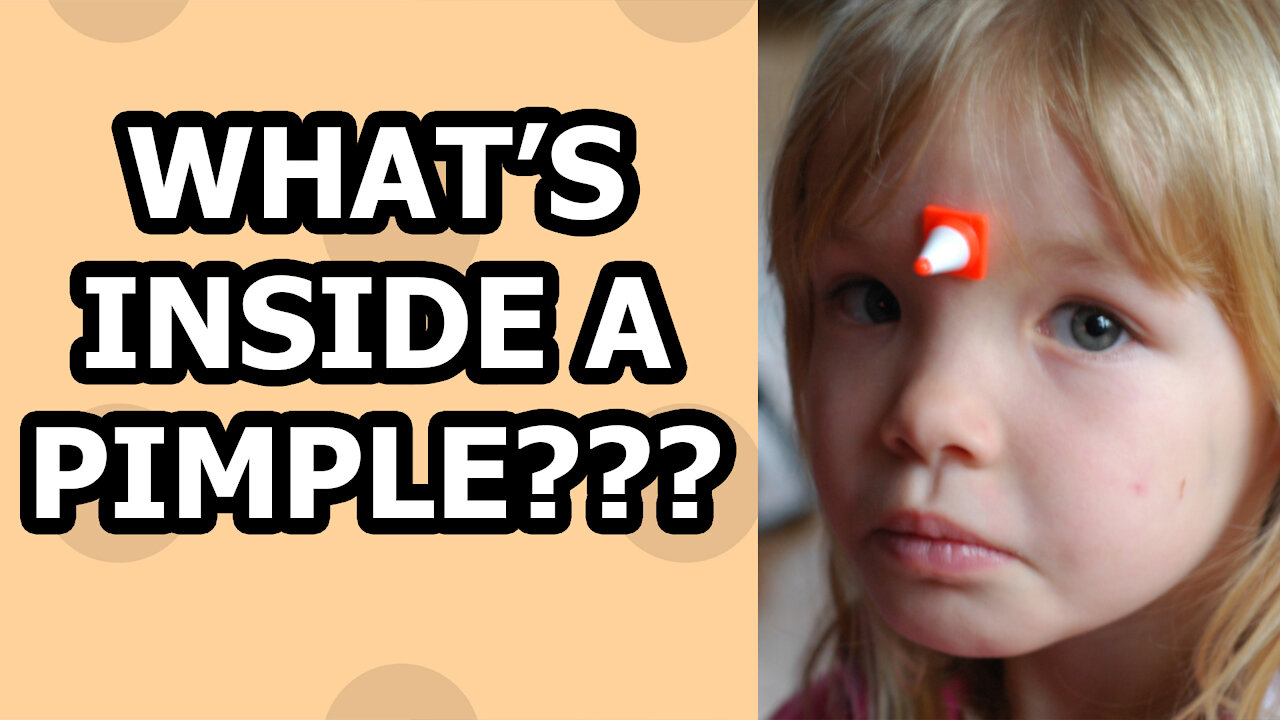 What Is inside a Pimple - The Bad The Ugly And The TRUTH