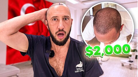 I Got A $2000 Hair Transplant In Turkey | The Night Shift