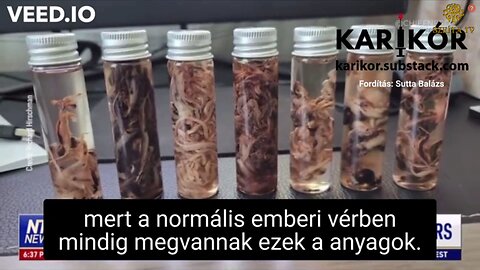 A balzsamozók korábban soha nem látott rostos vérrögöket találnak az elhunyt emberek szervezetében