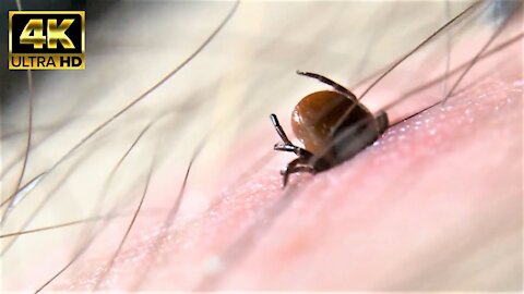 tick bite on human closeup