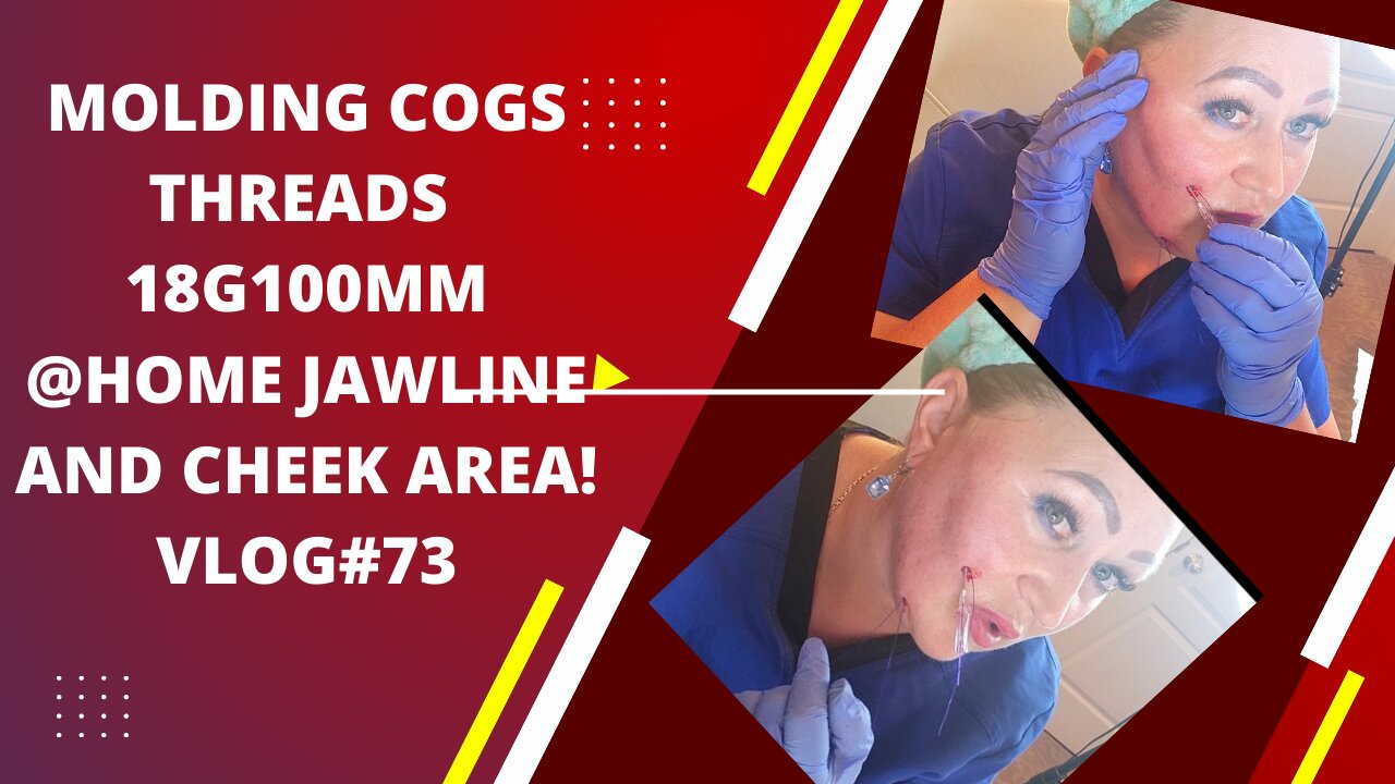 MOLDING 18G 100MM COGS THREADS AT HOME JAWLINE AND CHEEK AREA! VLOG#73