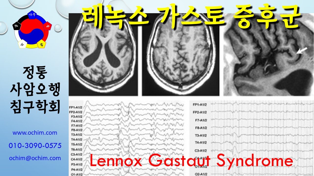 레녹스-가스토 증후군 치료 방법 - 사암침법, 사암오행침, 오행침, 정통사암침