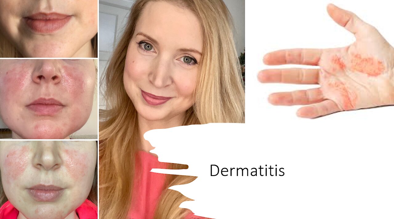 Dermatitis Natural Treatment