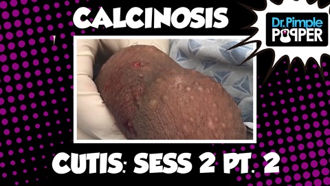 Calcinosis Cutis, Session Two, Part Two