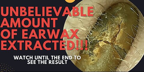 UNBELIEVABLE Amount Of Earwax Extracted From This Ear!!! (Watch Until The End)