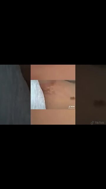 Satisfying Pimple Popping and Ingrowing Hair