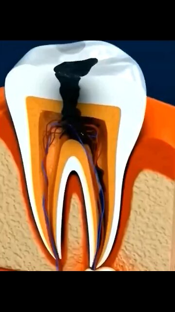 How Root Canal Treatment Works