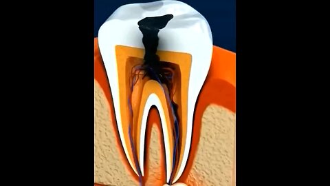 How Root Canal Treatment Works