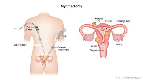 Robotic Assisted Myomectomy