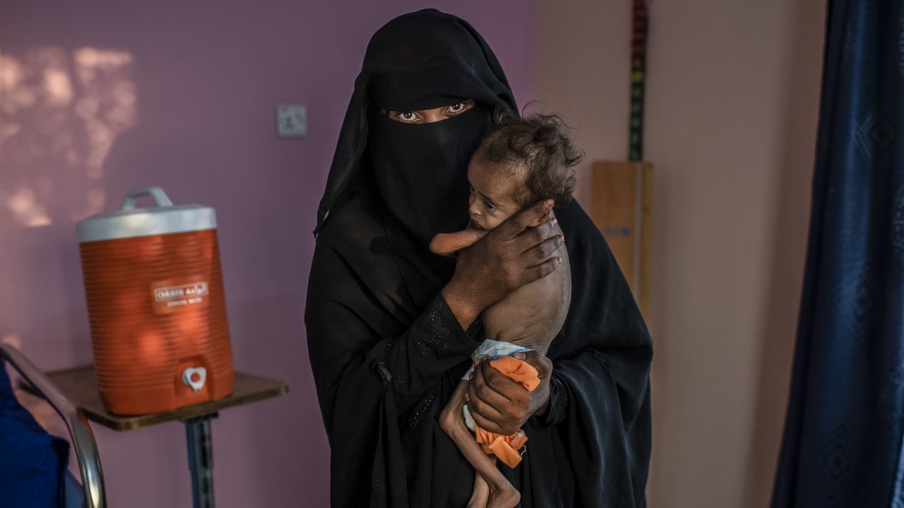 Yemen War May Have Caused 85,000 Children To Die From Starvation