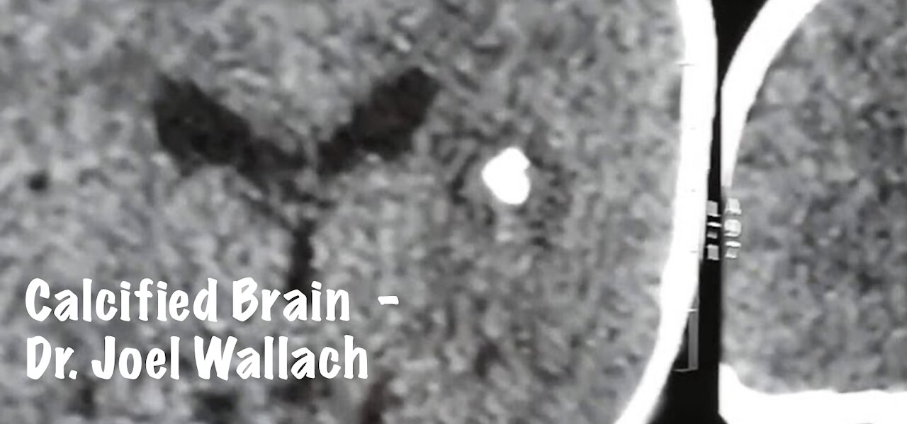 Calcified Brain Dr. Joel Wallach