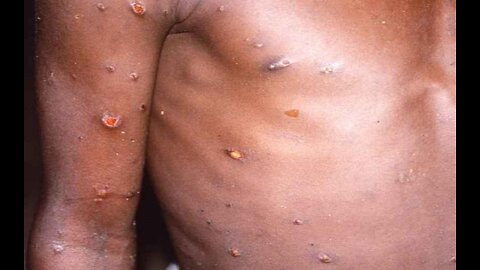 WHO Confirms 131 Worldwide Cases of Monkeypox, Says Outbreak Is 'Containable'