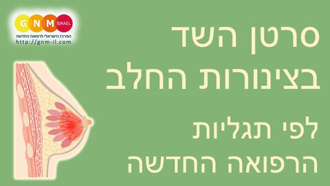 סרטן בצינורות החלב בשד - לפי תפיסת הרפואה החדשה