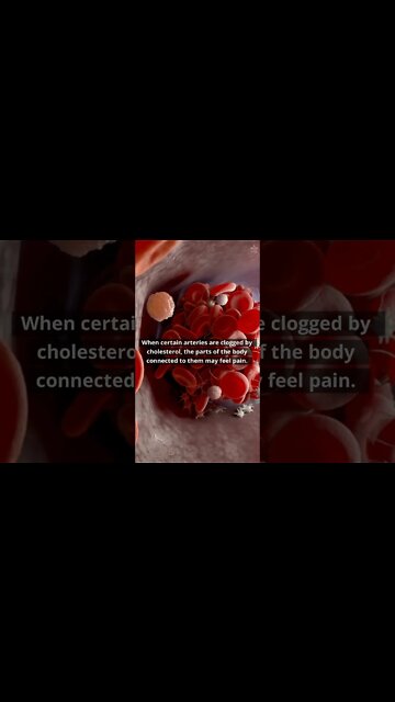 If You Feel This Kind Of Pain, You May Have High Cholesterol #shorts